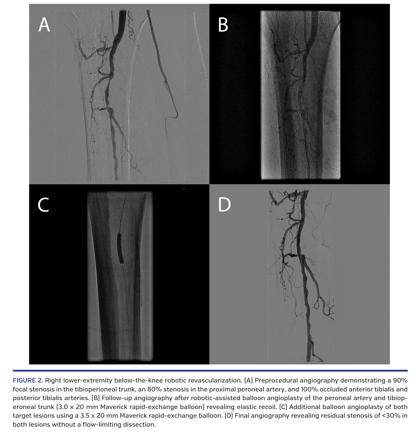 FIGURE 2. Right lower-extremity below-the-knee robotic revascularization..png