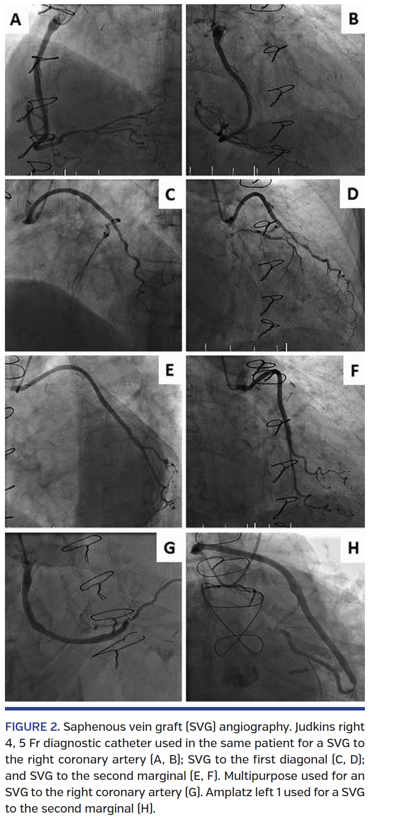 FIGURE 2. Saphenous vein graft (SVG) angiography..png