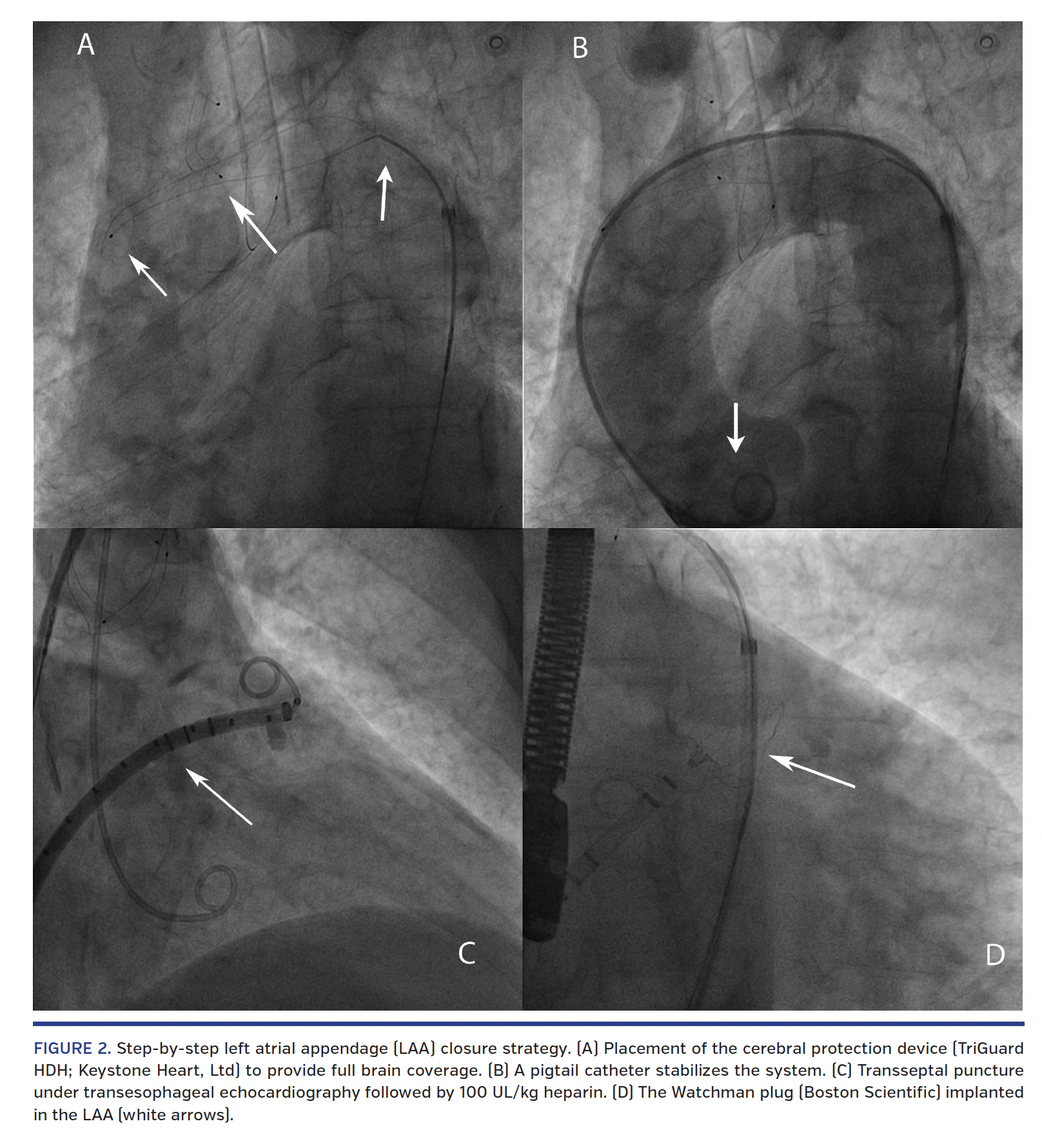 FIGURE 2. Step-by-step left atrial appendage (LAA) closure strategy..png