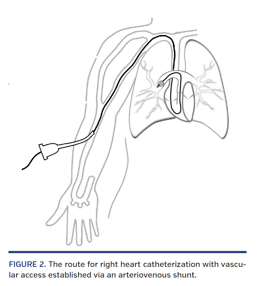 FIGURE 2. The route for right heart catheterization.png