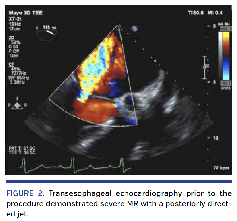 FIGURE 2. Transesophageal echocardiography.png