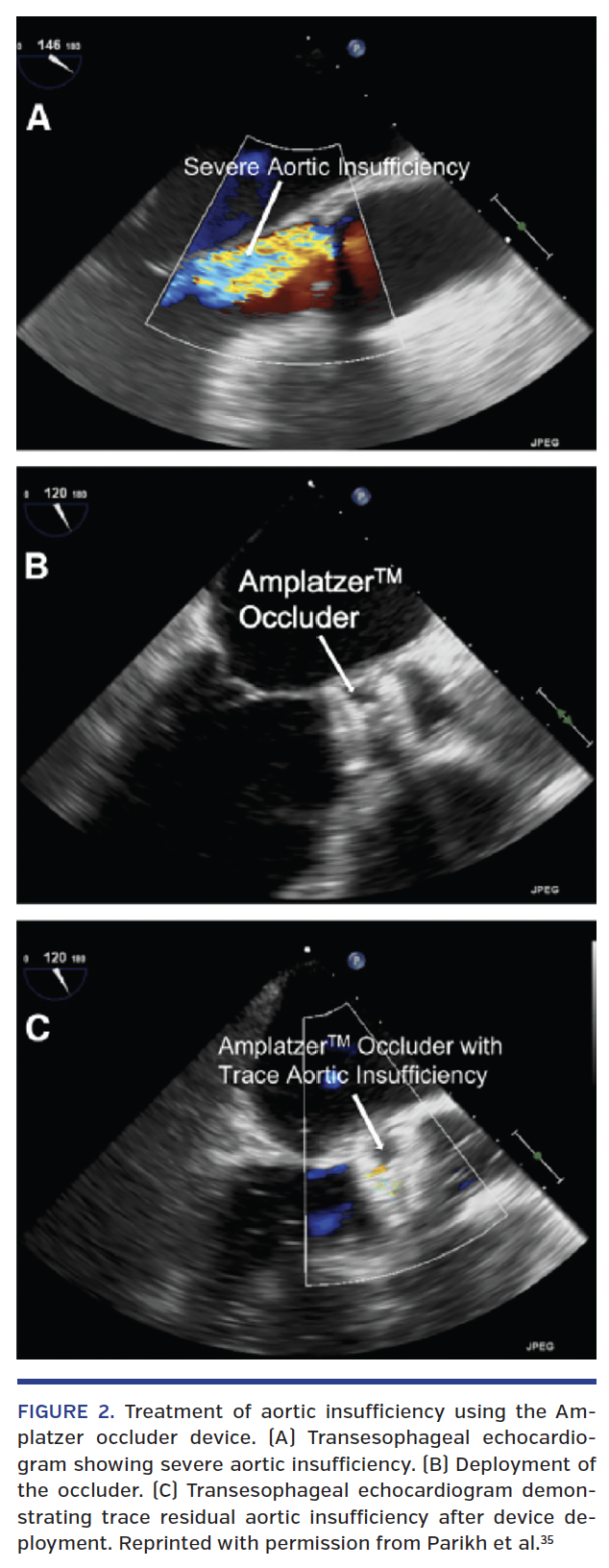 FIGURE 2. Treatment of aortic insufficiency.png