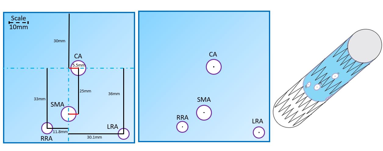 Figure 2. For modification of the stent graft, an option would be to use a transparent sterile plastic piece, such as those used in instrument packaging to measure distances and mark the fenestration positions. 