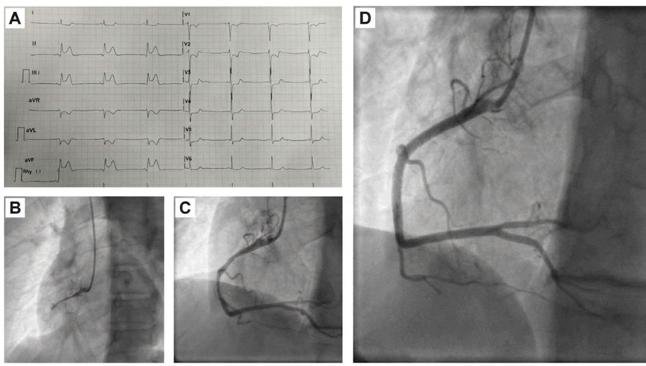 Figure 2. (A) Electrocardiogram at the time of chest pain