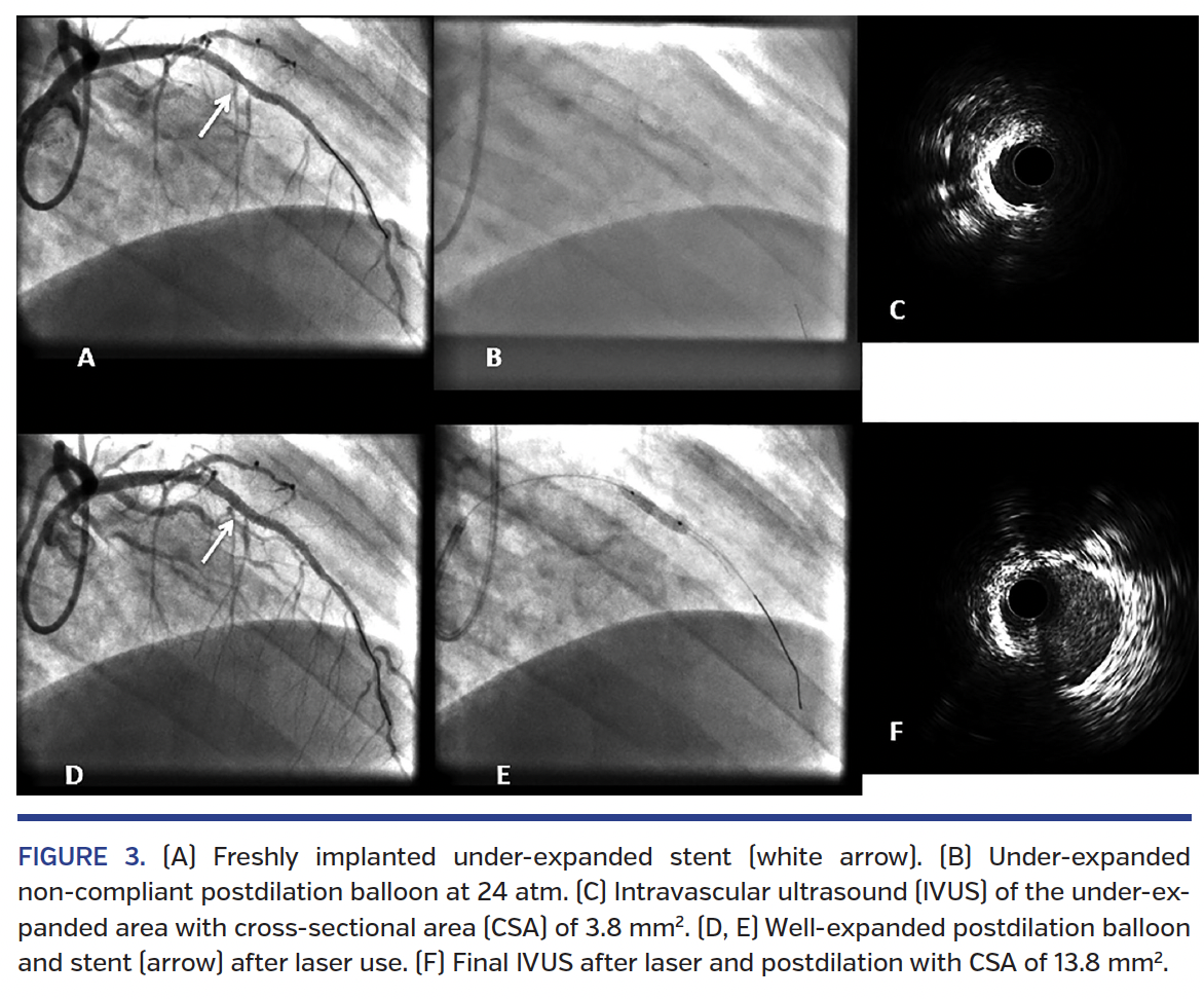 FIGURE 3. (A) Freshly implanted under-expanded stent.png