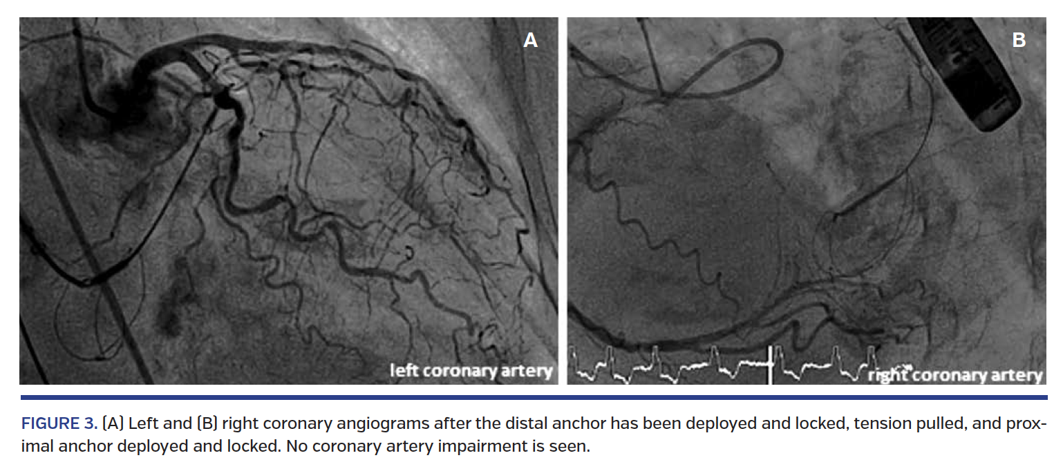         FIGURE 3. (A) Left and (B) right coronary angiograms.png
