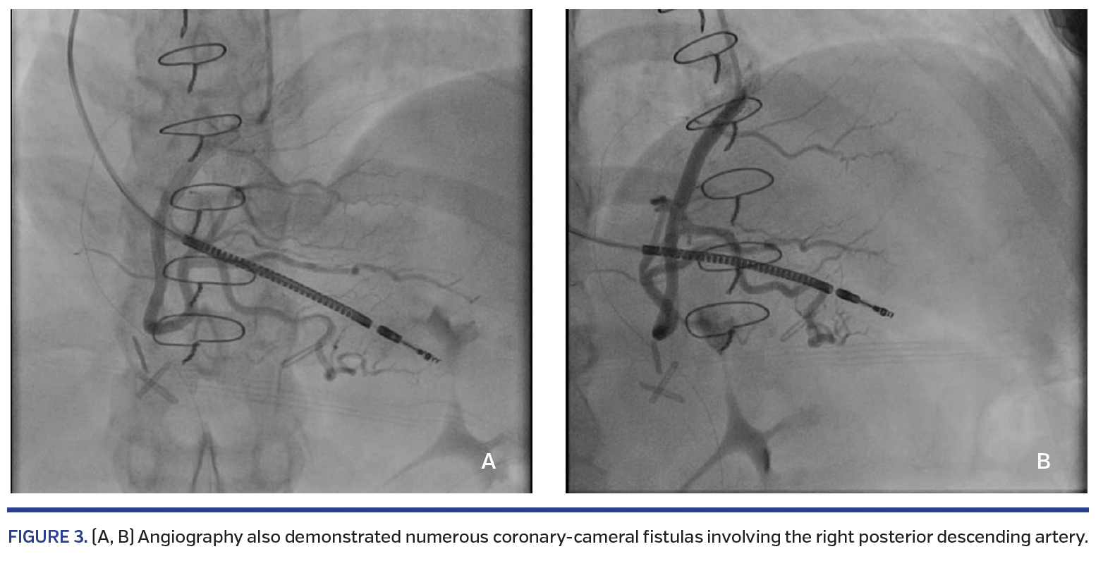 FIGURE 3. (A, B) Angiography.png