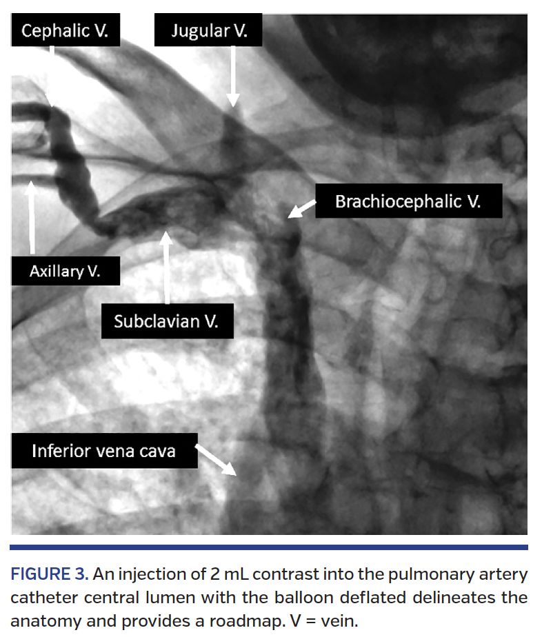 FIGURE 3. An injection of 2 mL contrast into.png