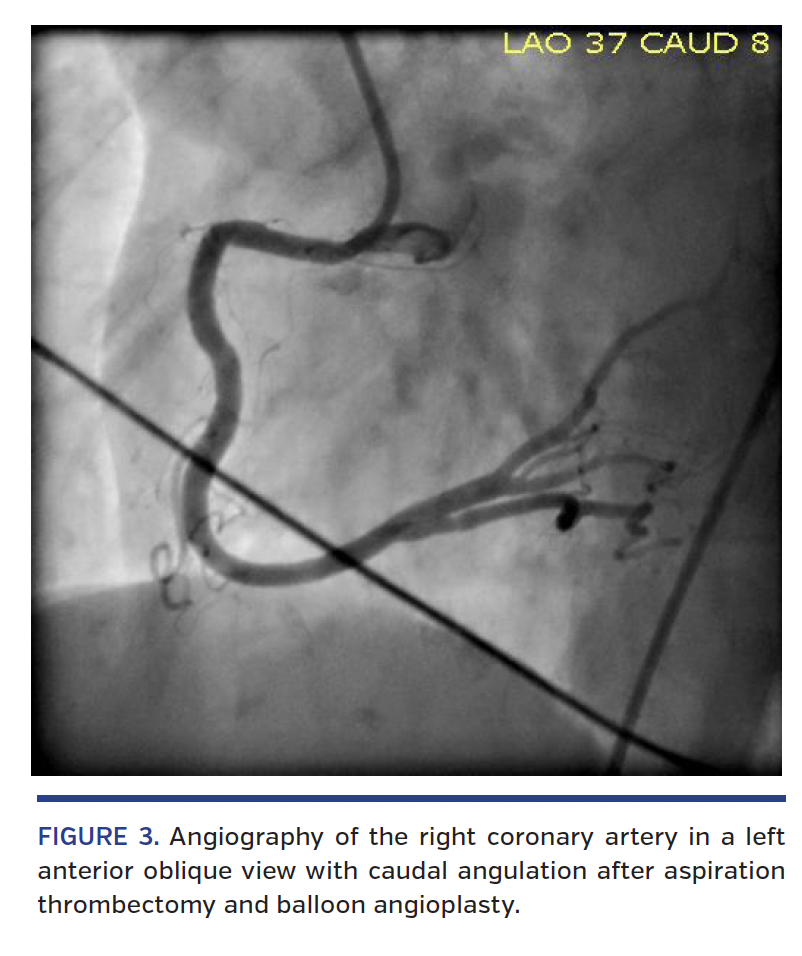 FIGURE 3. Angiography of the right coronary artery.png
