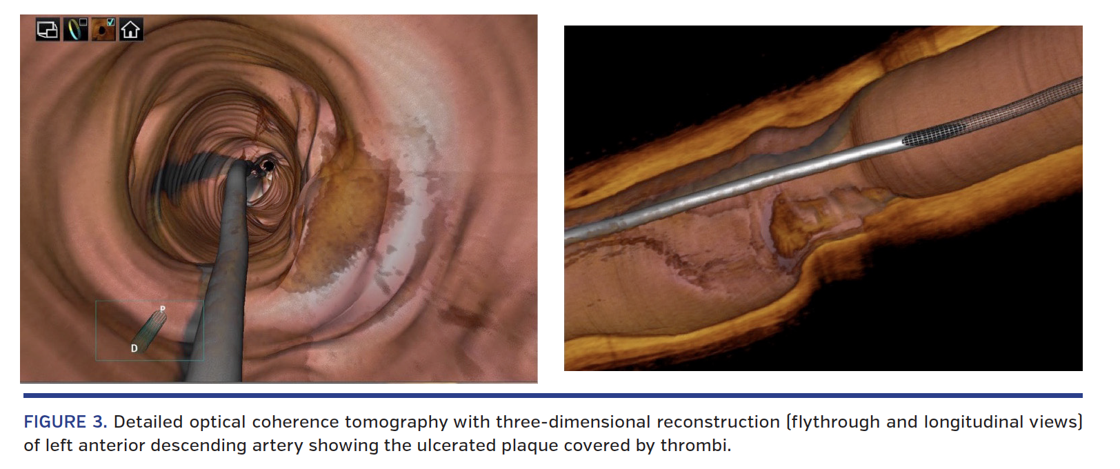 FIGURE 3. Detailed optical coherence tomography.png