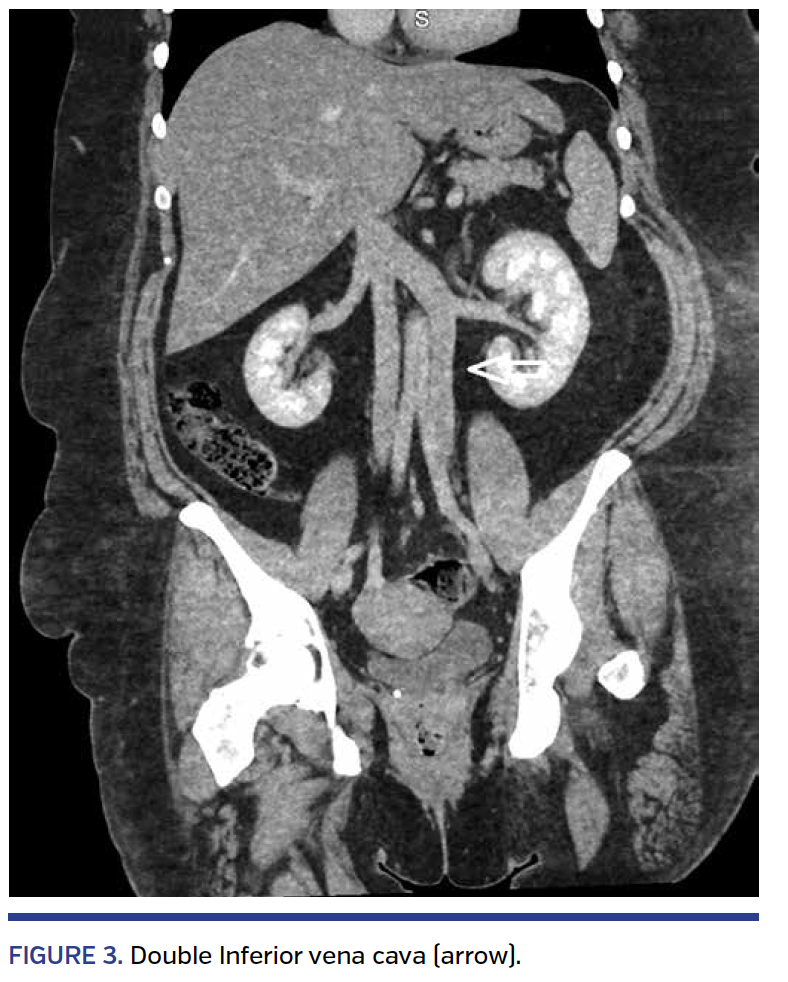FIGURE 3. Double Inferior vena cava (arrow)..png