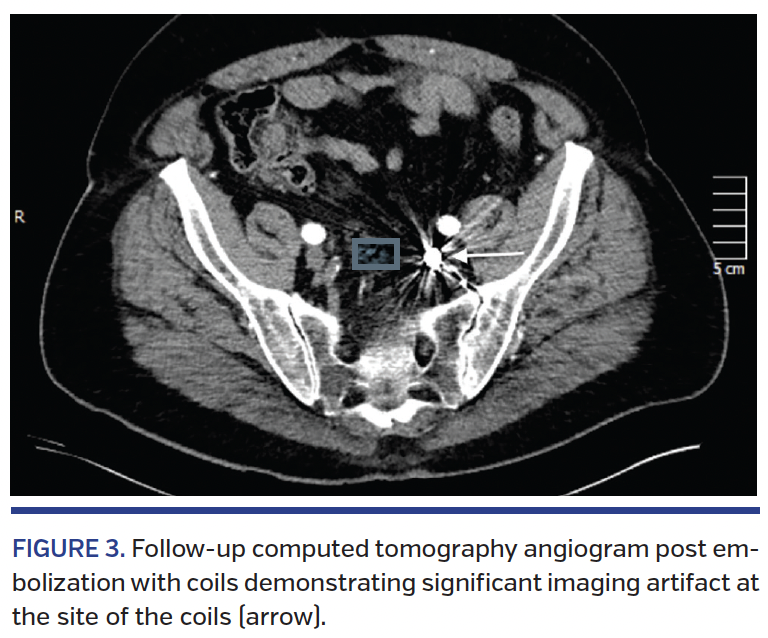 FIGURE 3. Follow-up computed tomography.png