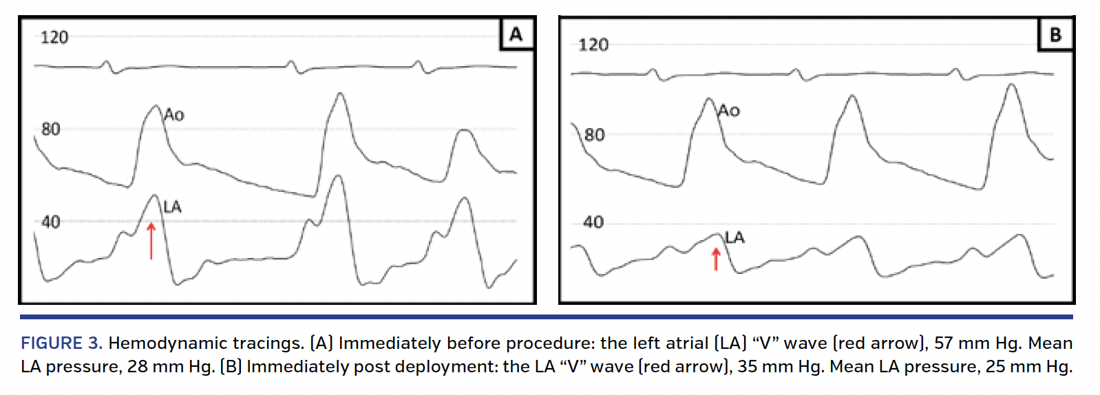 FIGURE 3. Hemodynamic tracings..png