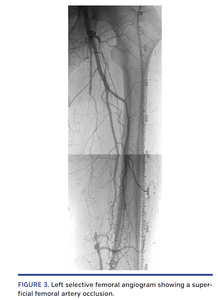 FIGURE 3. Left selective femoral angiogram.png