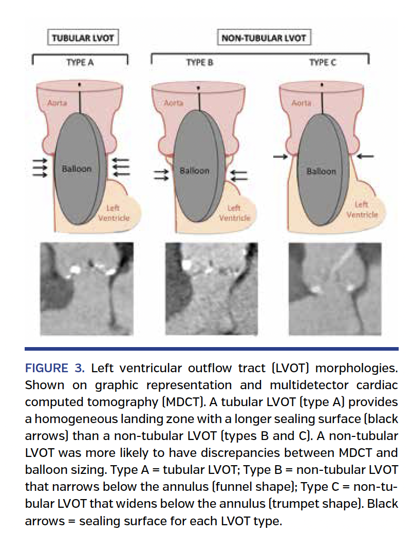 FIGURE 3. Left ventricular outflow tract.png