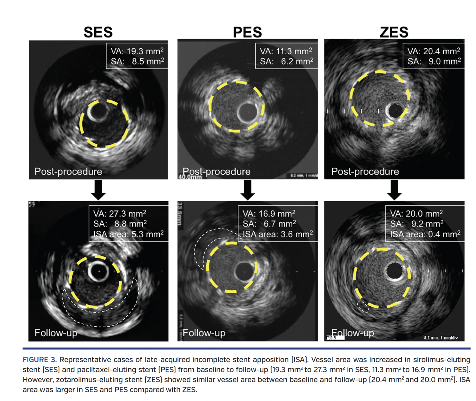 FIGURE 3. Representative cases of late-acquired incomplete stent apposition.png