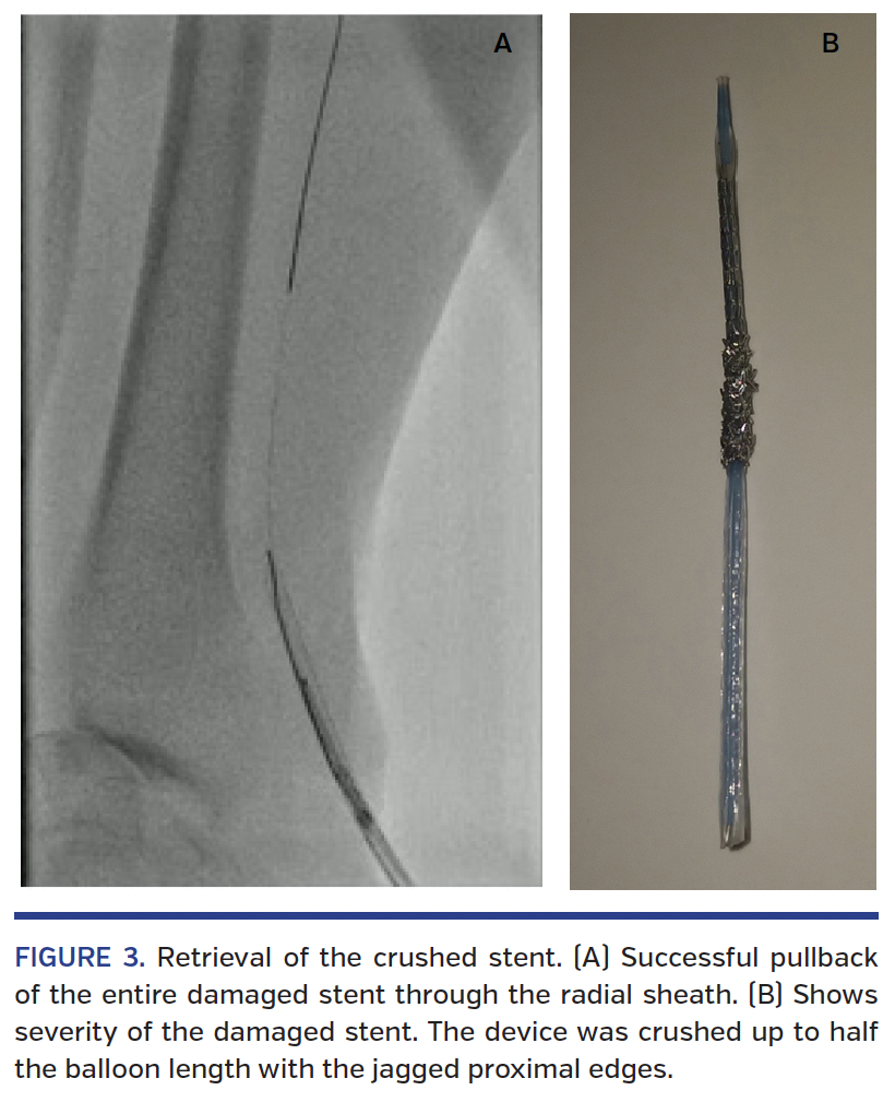 FIGURE 3. Retrieval of the crushed stent..png