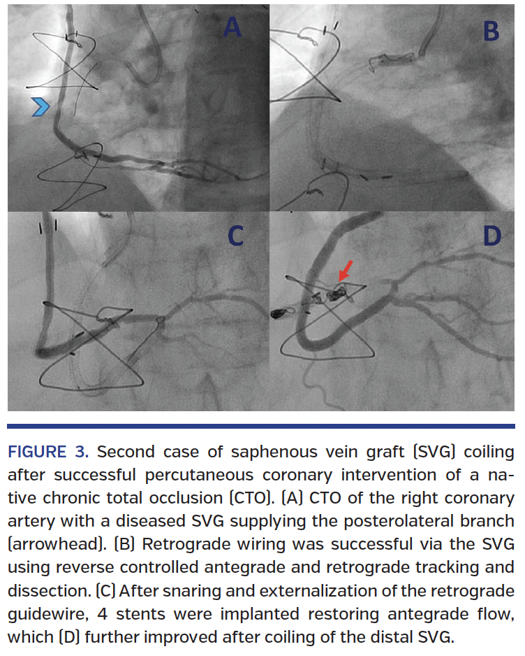 FIGURE 3. Second case of saphenous vein graft.png