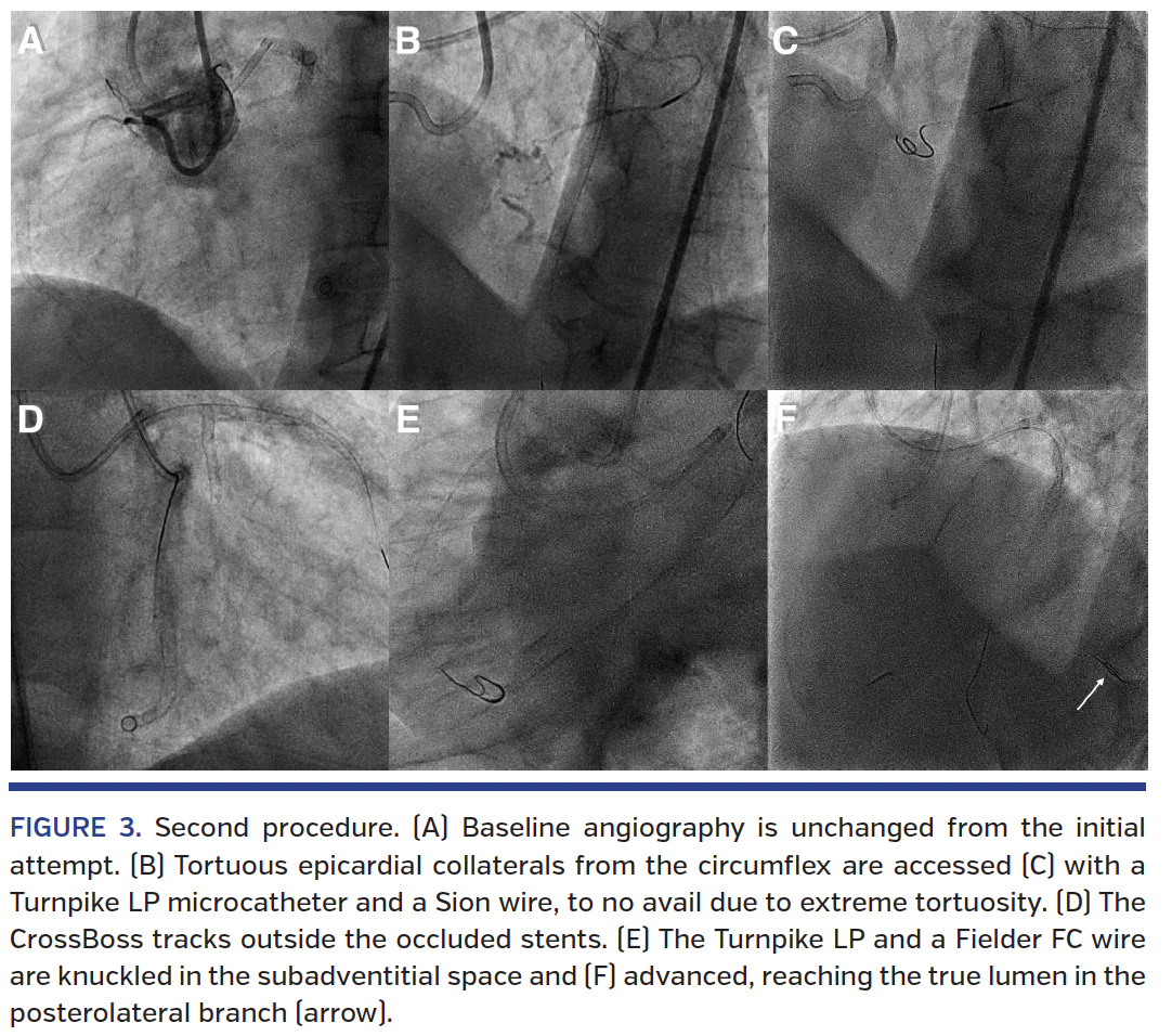 FIGURE 3. Second procedure..png