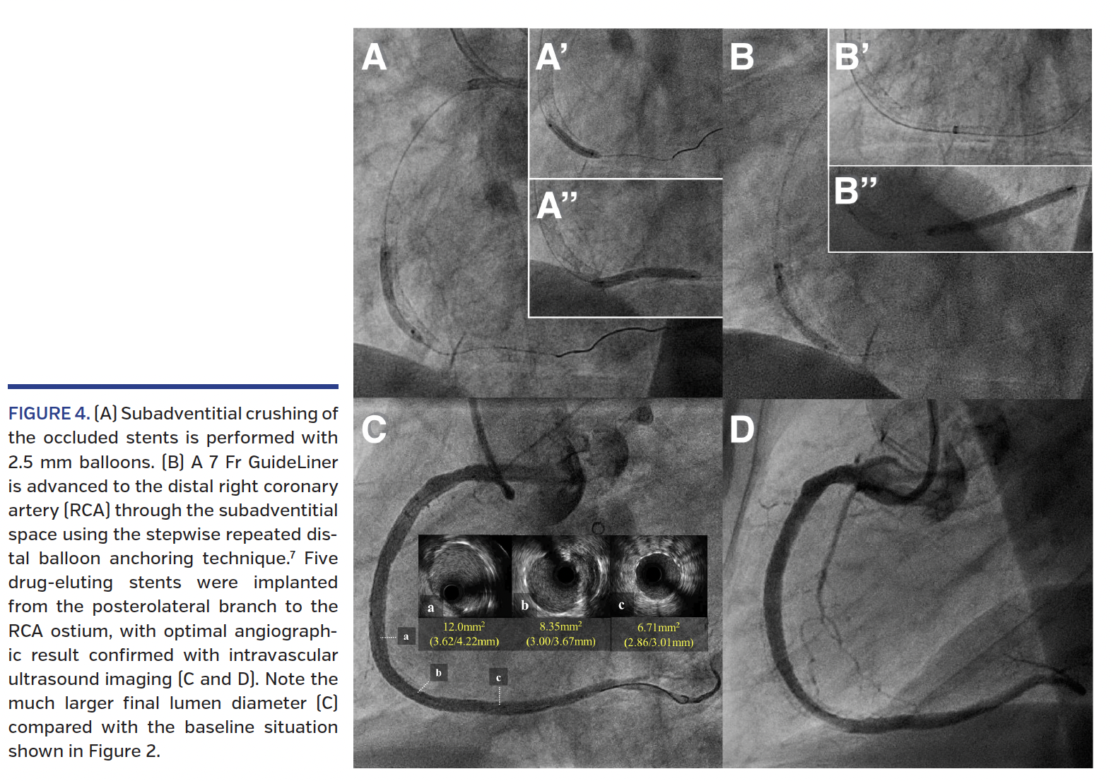 FIGURE 4. (A) Subadventitial crushing of the occluded stents.png