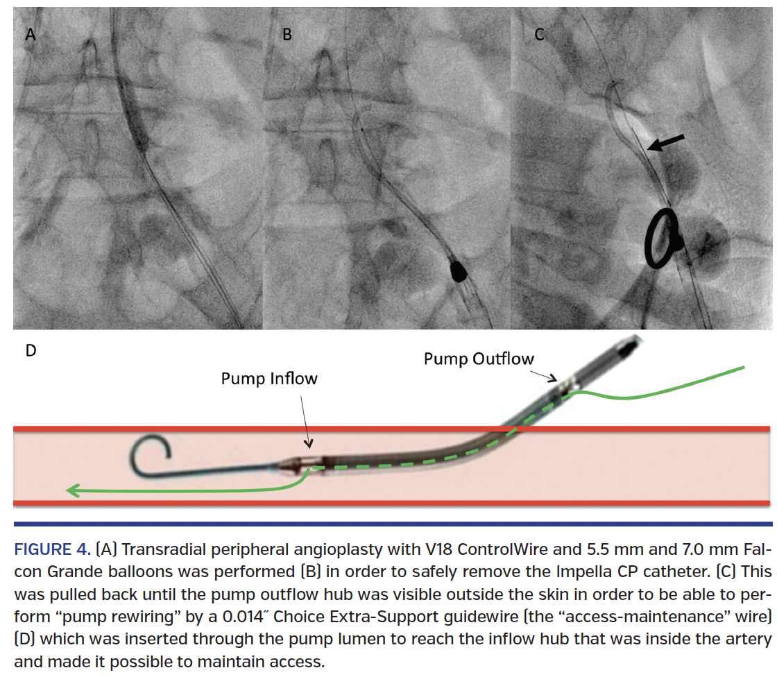 FIGURE 4. (A) Transradial peripheral angioplasty with V18 ControlWire.png