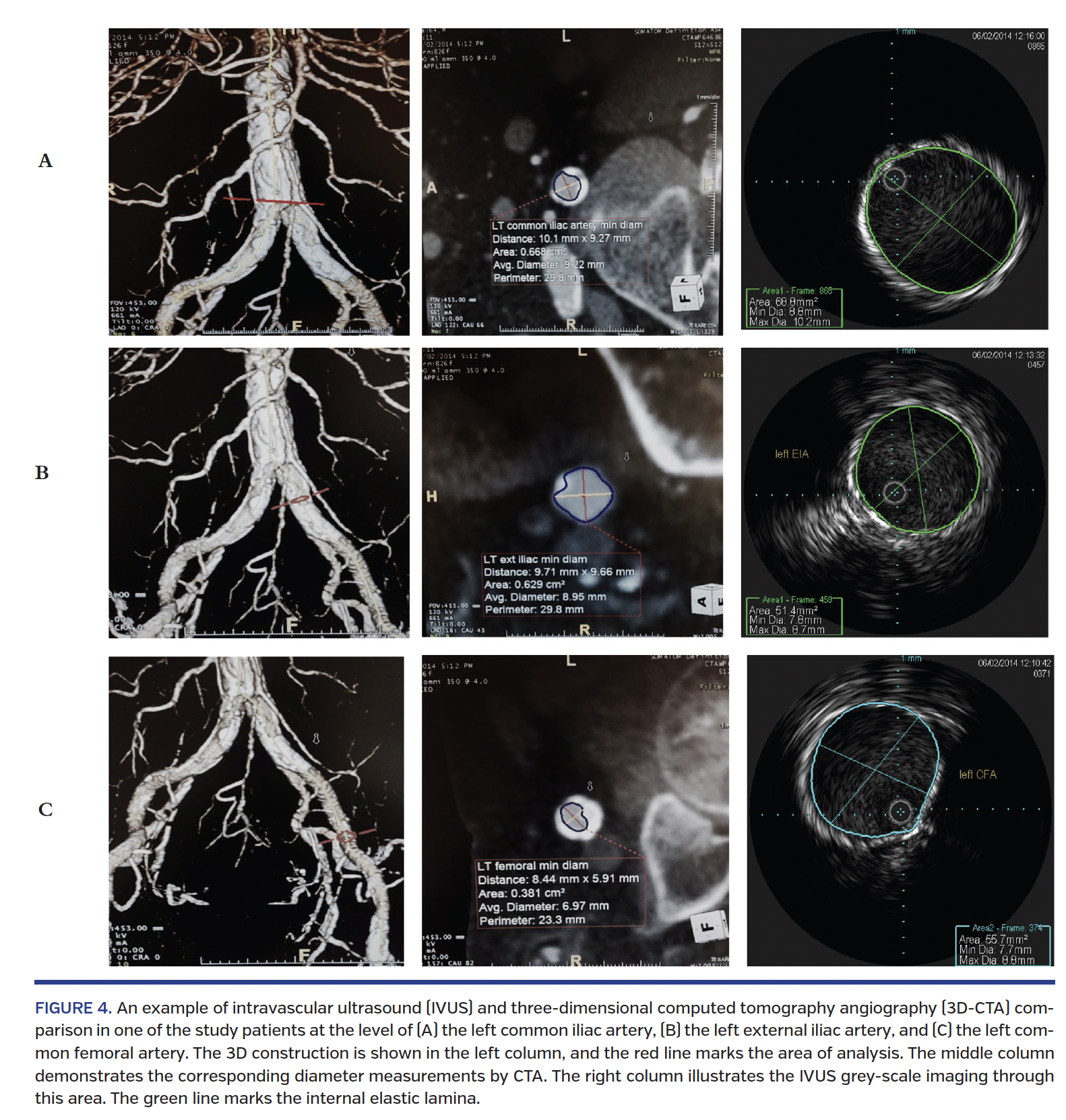 FIGURE 4. An example of intravascular ultrasound.png