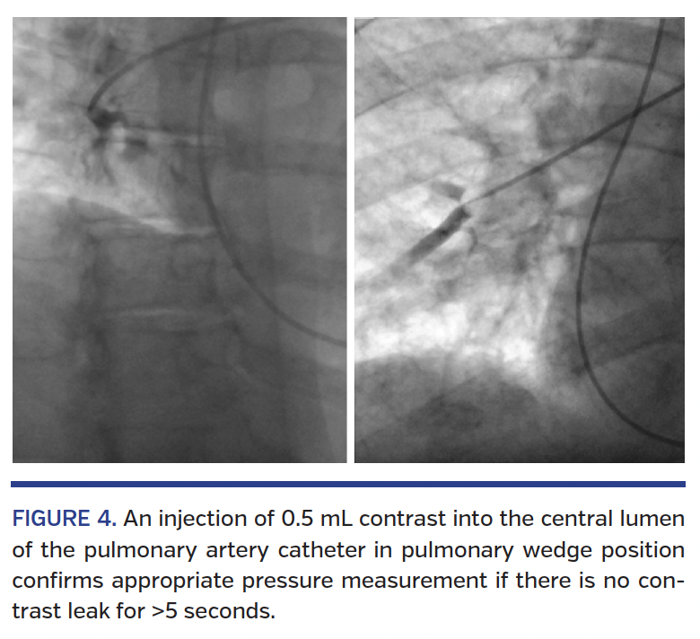 FIGURE 4. An injection of 0.5 mL contrast.png