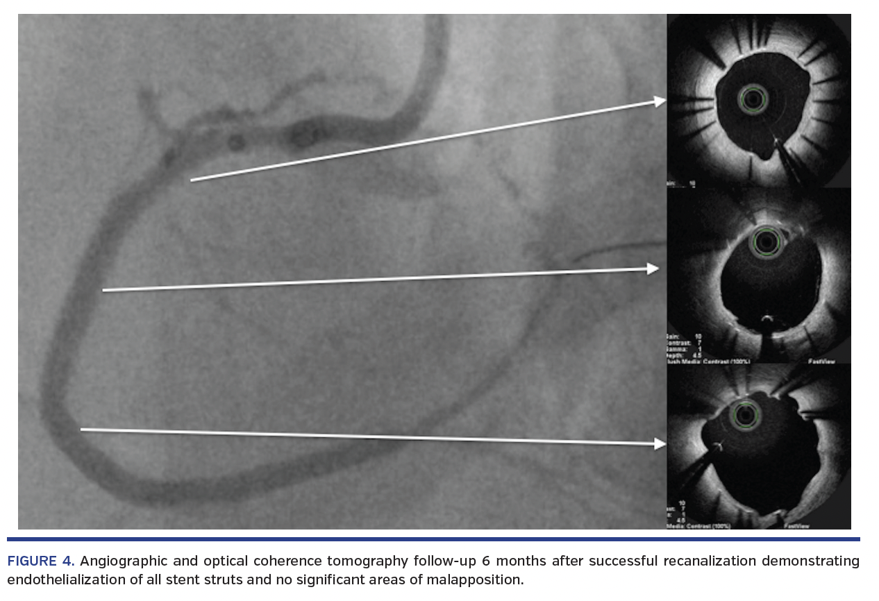 FIGURE 4. Angiographic and optical coherence tomography.png