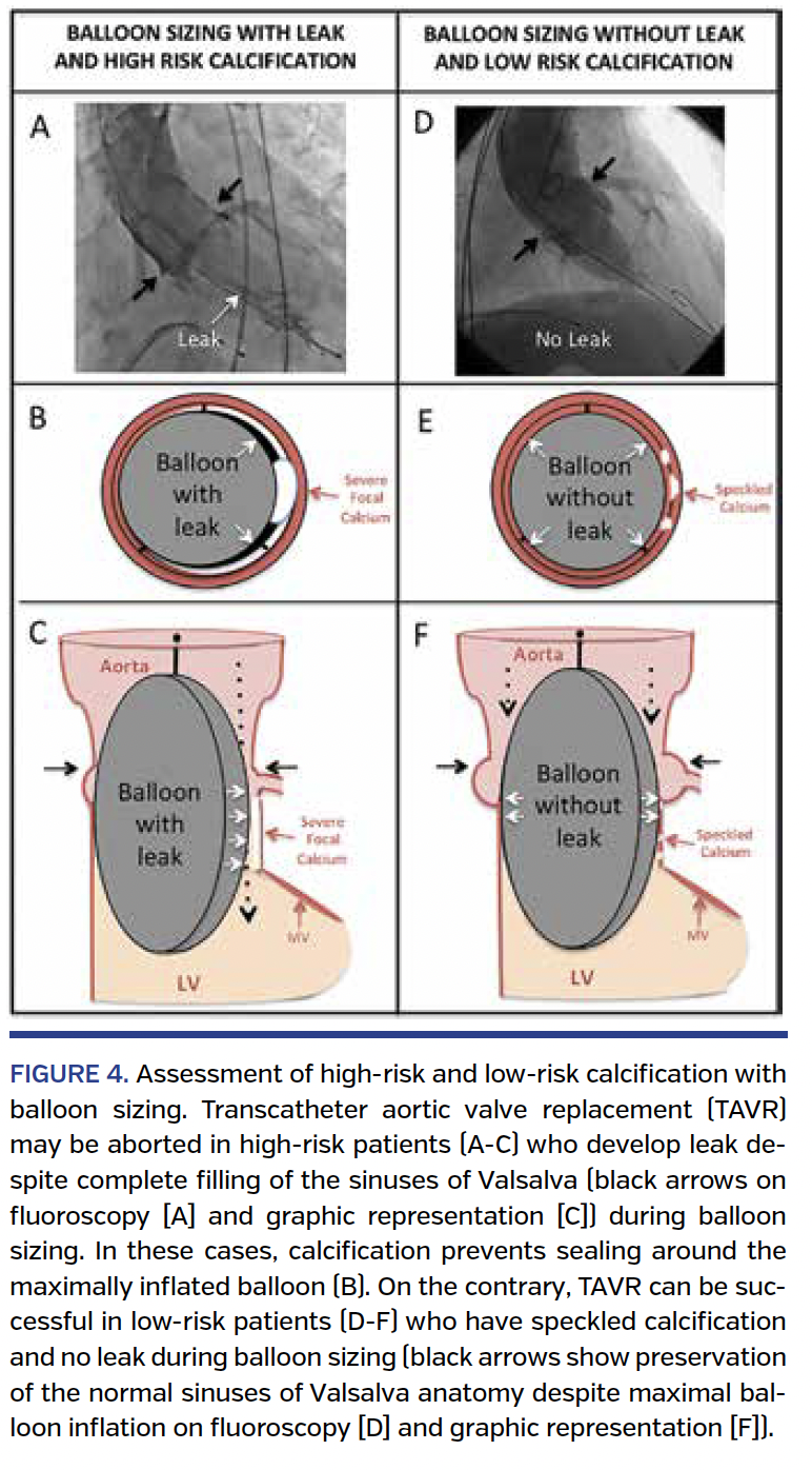FIGURE 4. Assessment of high-risk and low-risk calcification.png