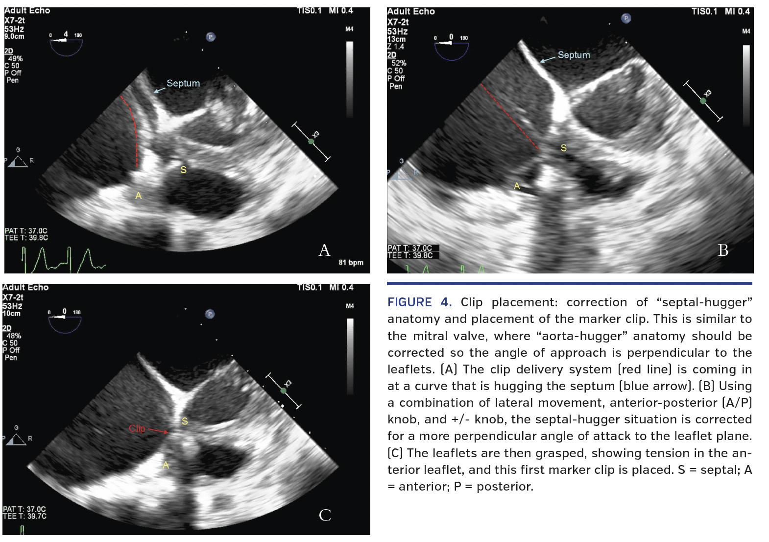 FIGURE 4. Clip placement.png