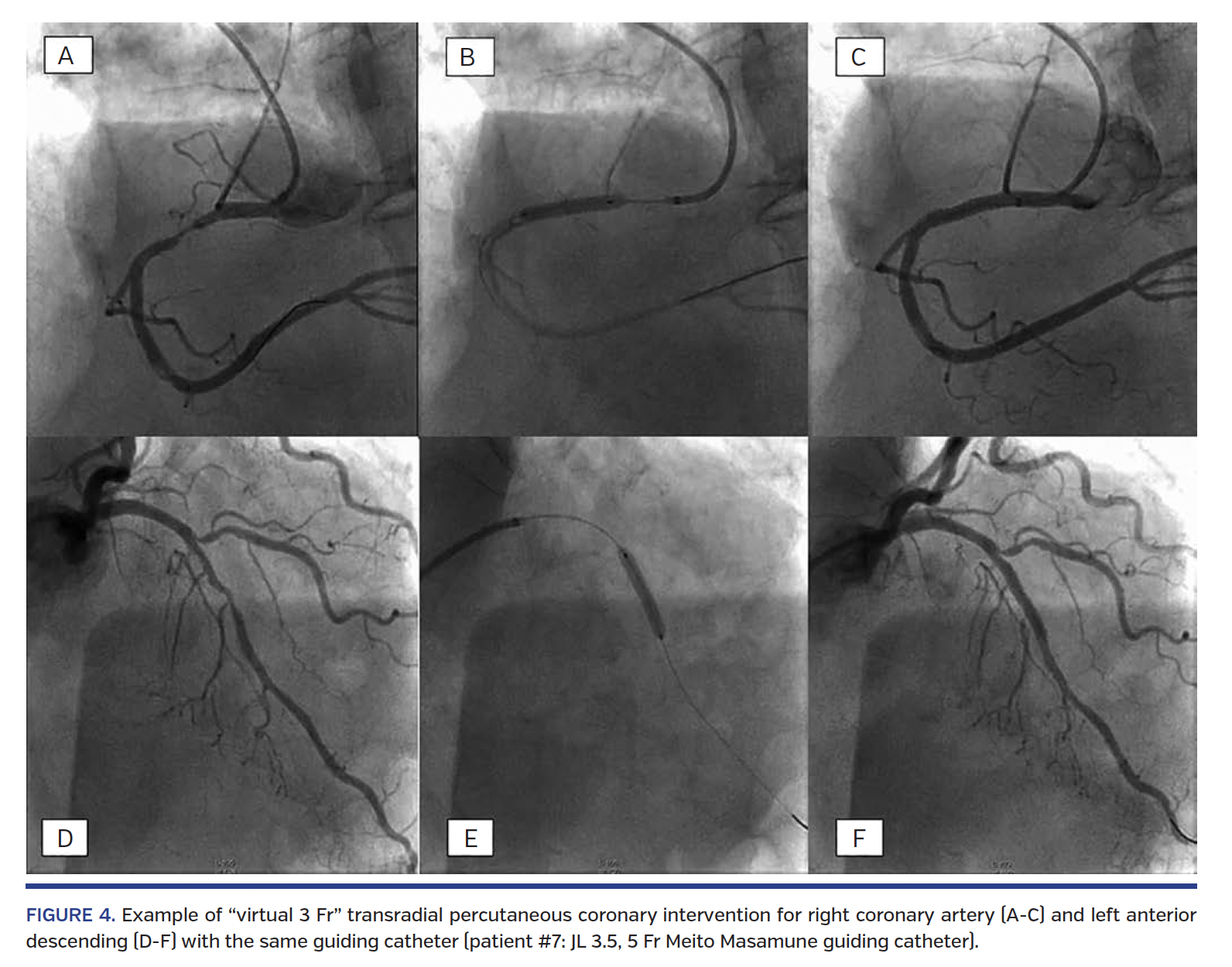 FIGURE 4. Example of “virtual 3 Fr” transradial percutaneous coronary intervention for right coronary artery.png