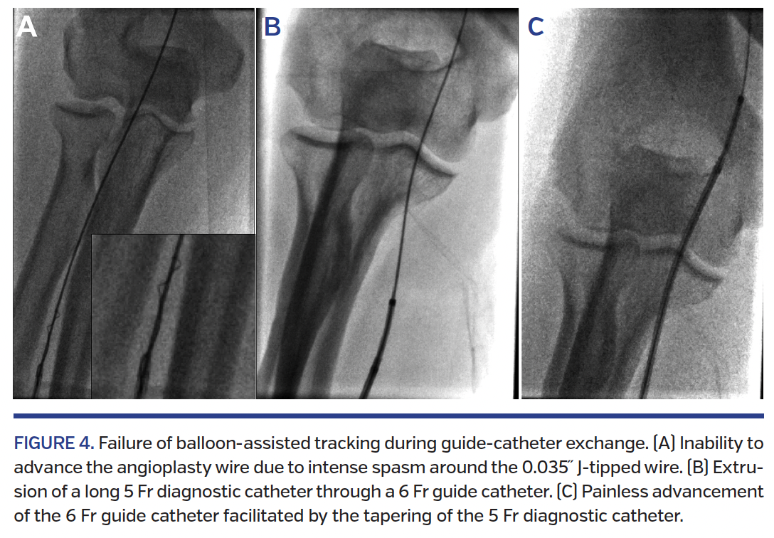 FIGURE 4. Failure of balloon-assisted tracking.png