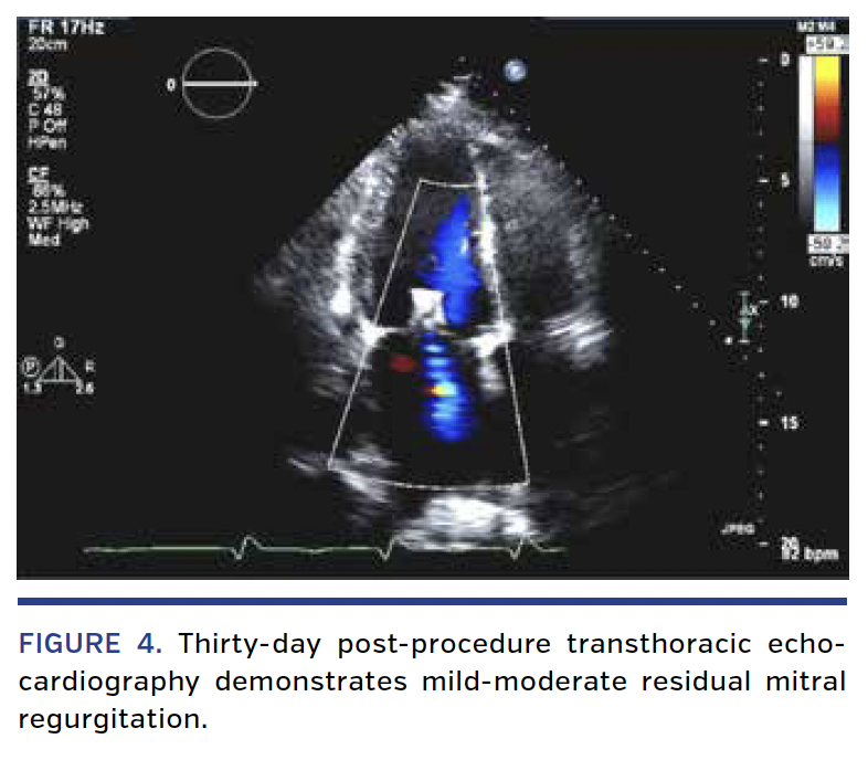 FIGURE 4. Thirty-day post-procedure transthoracic echocardiography.png
