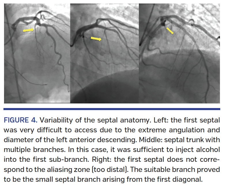FIGURE 4. Variability of the septal anatomy..png