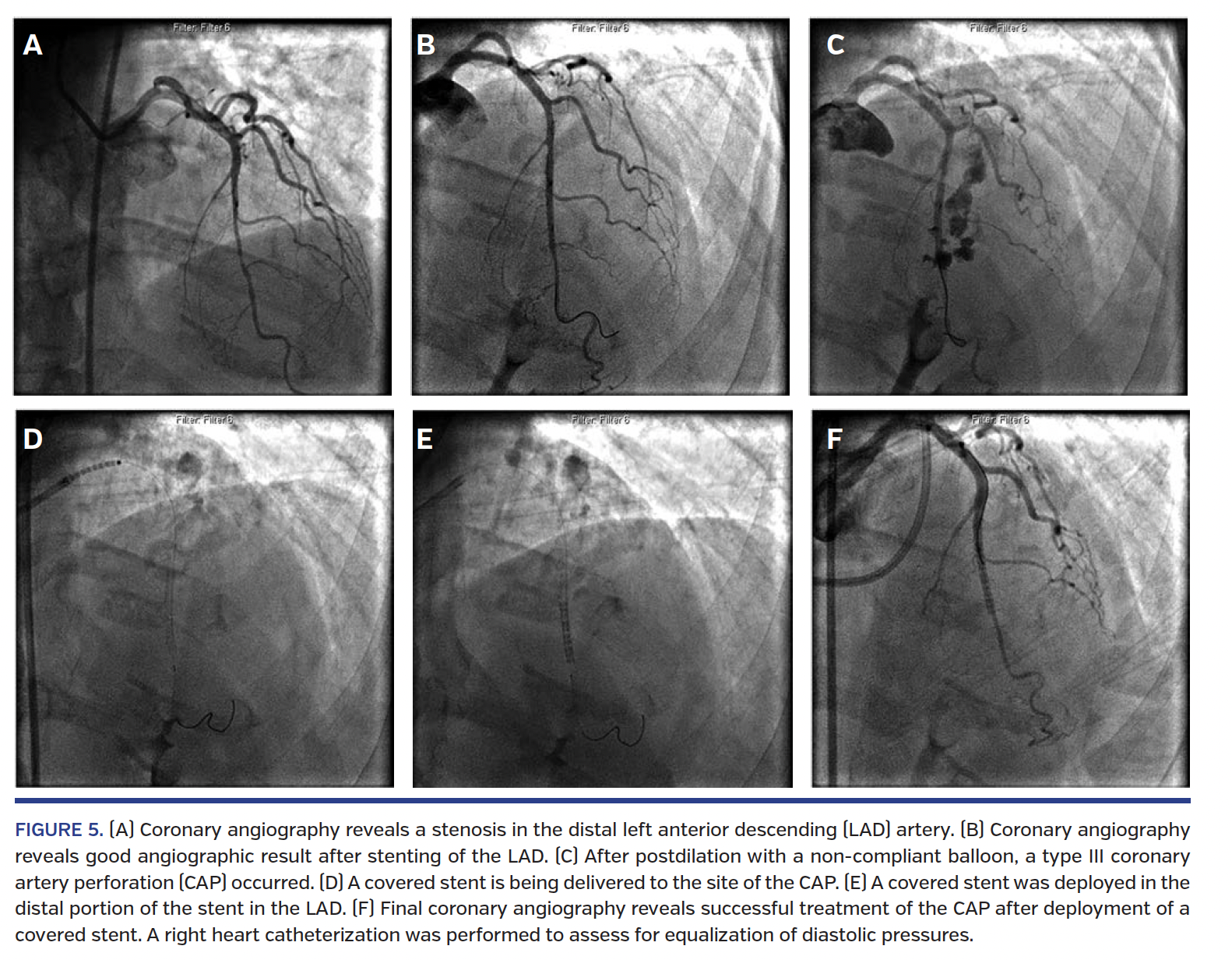 xFIGURE 5. (A) Coronary angiography reveals a stenosis in the distal left anterior descending (LAD) artery..png