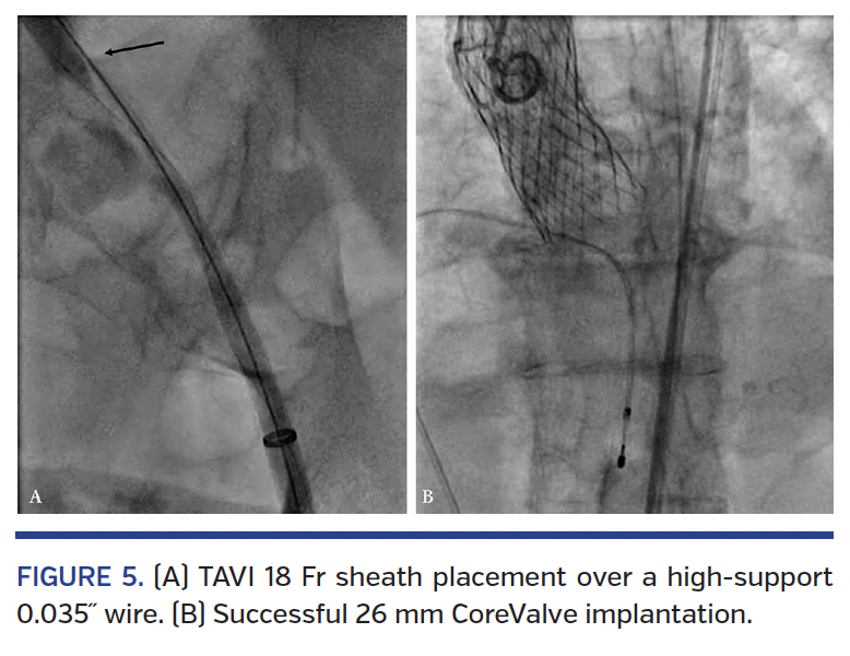 FIGURE 5. (A) TAVI 18 Fr sheath placement.png
