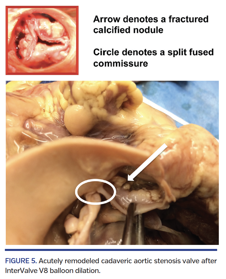 FIGURE 5. Acutely remodeled cadaveric aortic stenosis.png