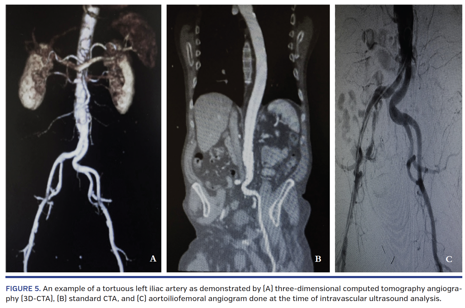 FIGURE 5. An example of a tortuous left iliac artery.png