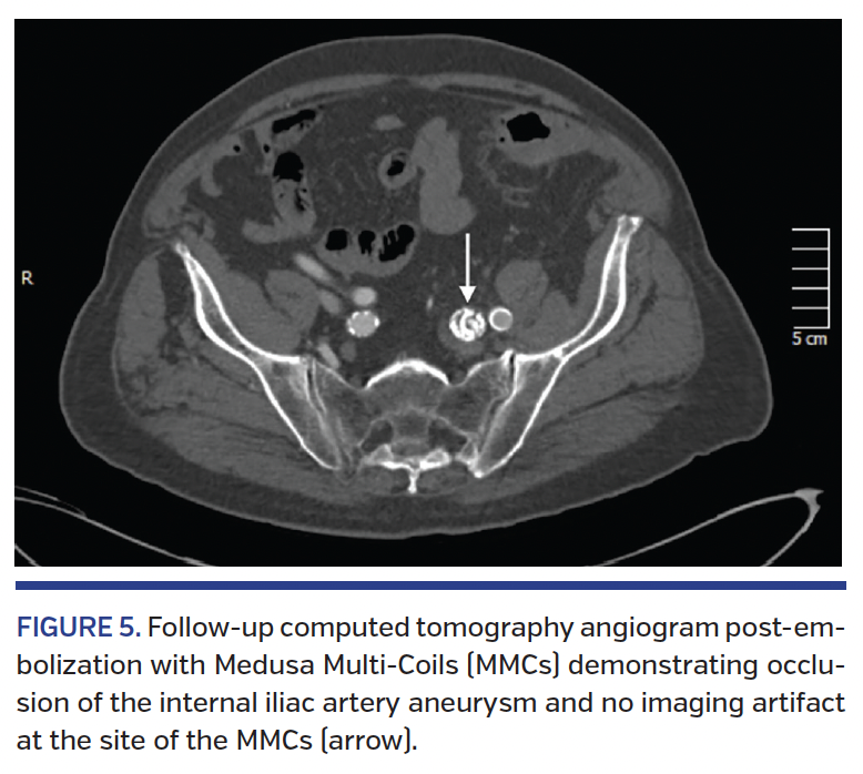 FIGURE 5. Follow-up computed tomography.png