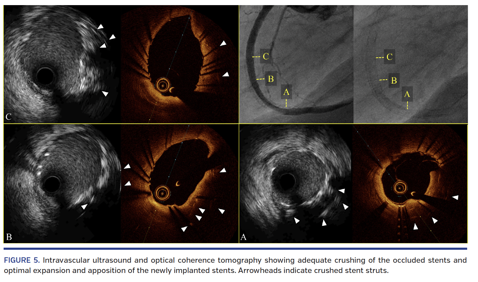 FIGURE 5. Intravascular ultrasound.png