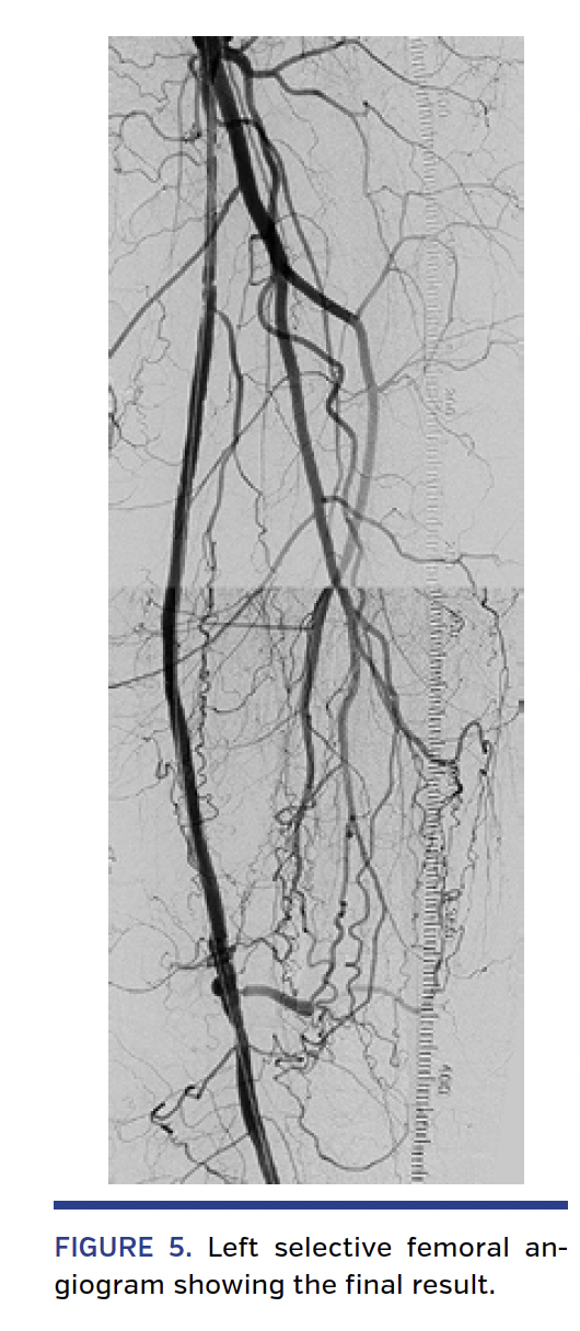 FIGURE 4. True lumen reentry facilitated by the ShockWire..png