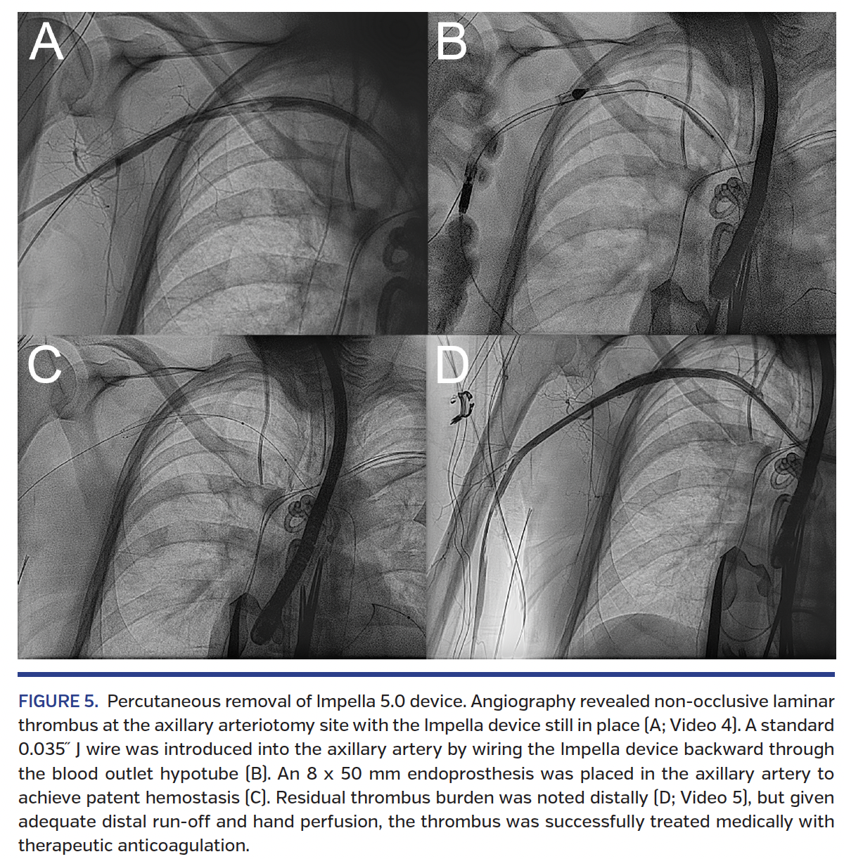 FIGURE 5. Percutaneous removal of Impella.png