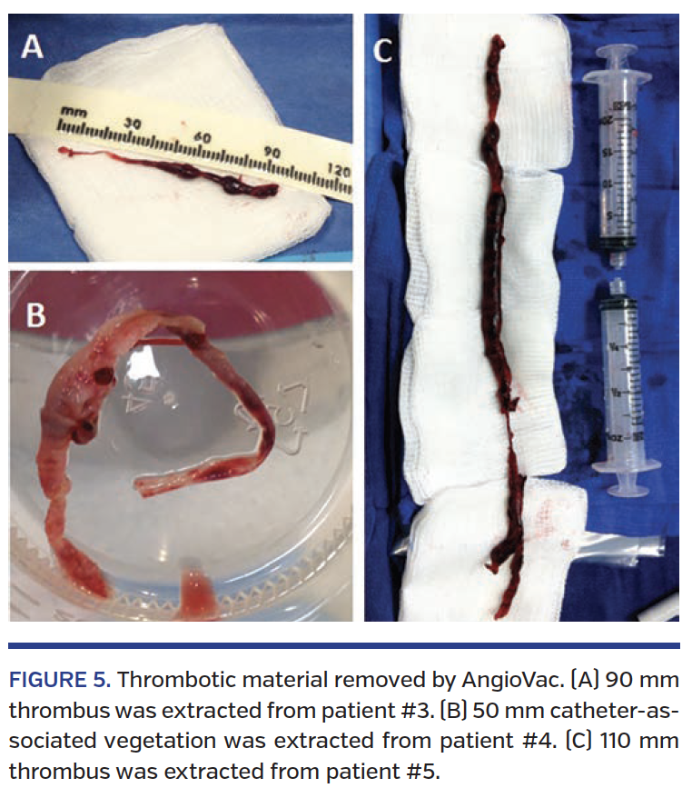 FIGURE 5. Thrombotic material removed by AngioVac..png