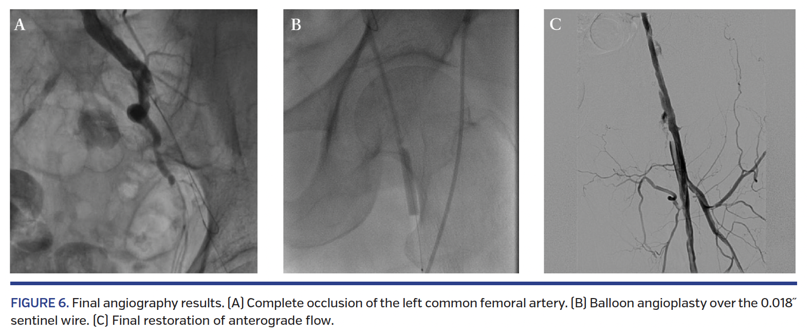 FIGURE 6. Final angiography results..png