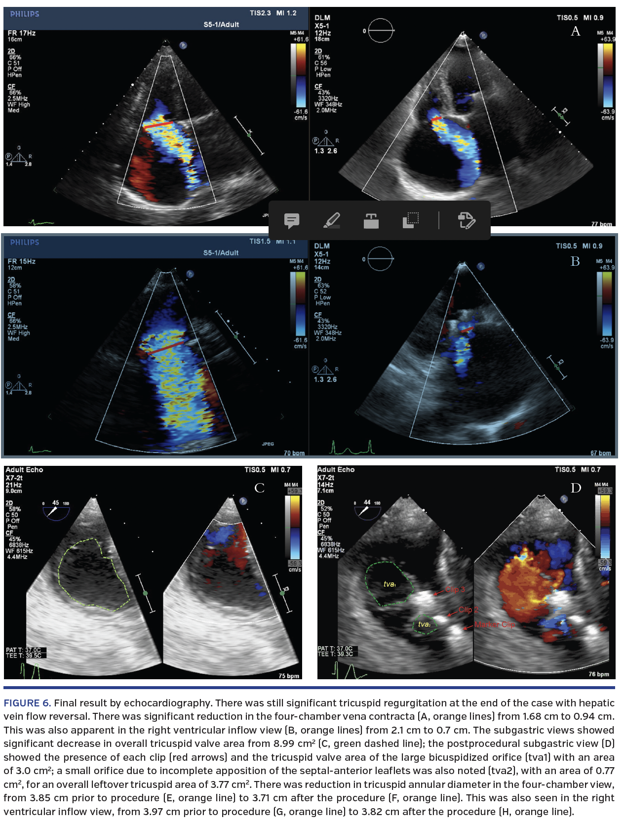 FIGURE 6. Final result by echocardiography..png