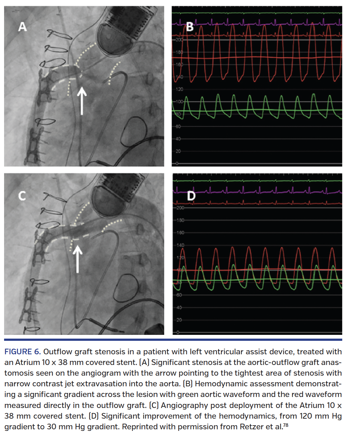 FIGURE 6. Outflow graft stenosis.png