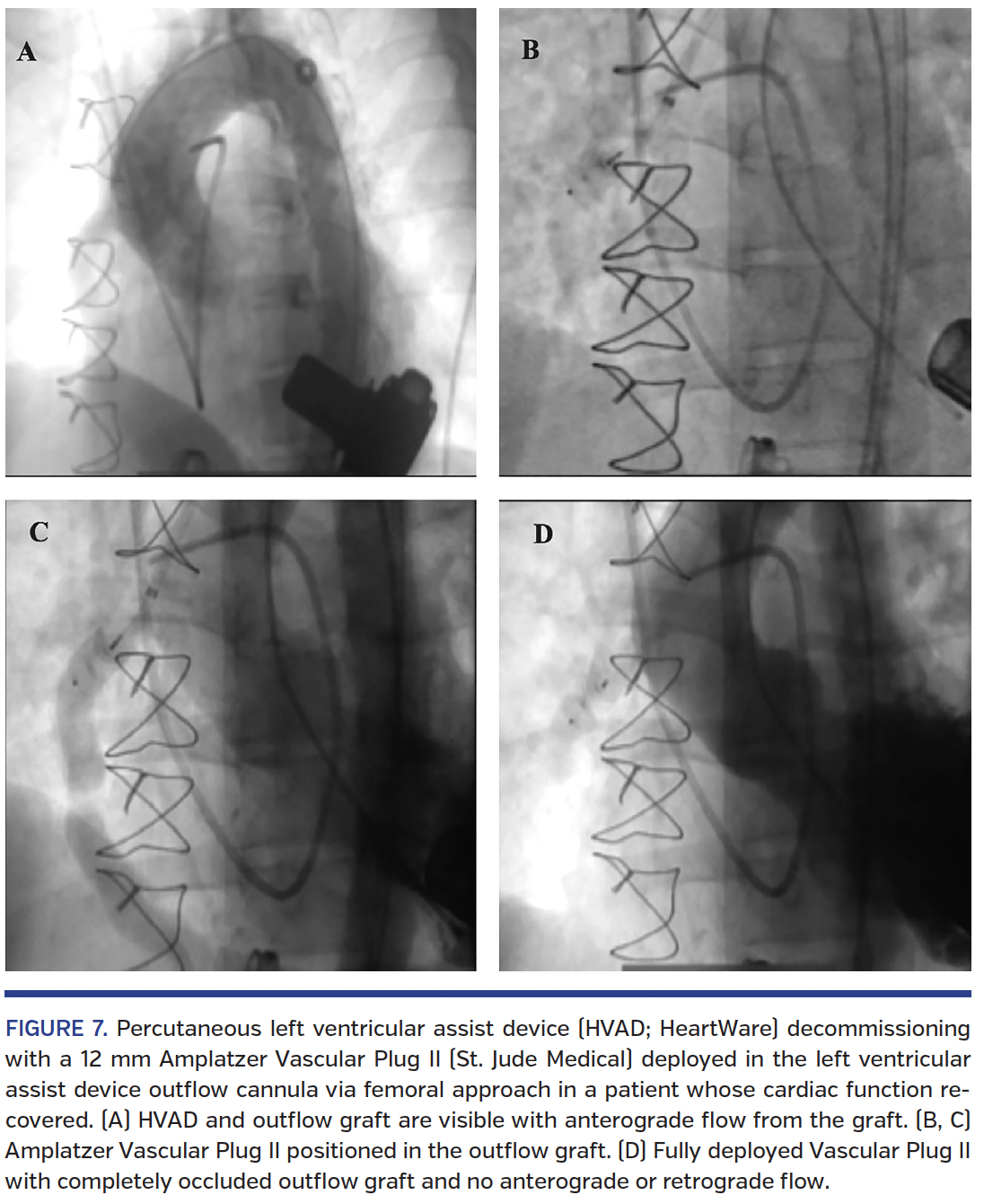 FIGURE 7. Percutaneous left ventricular assist device.png