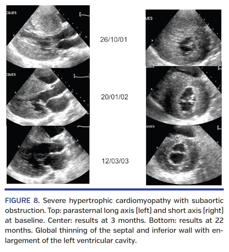 FIGURE 8. Severe hypertrophic cardiomyopathy.png