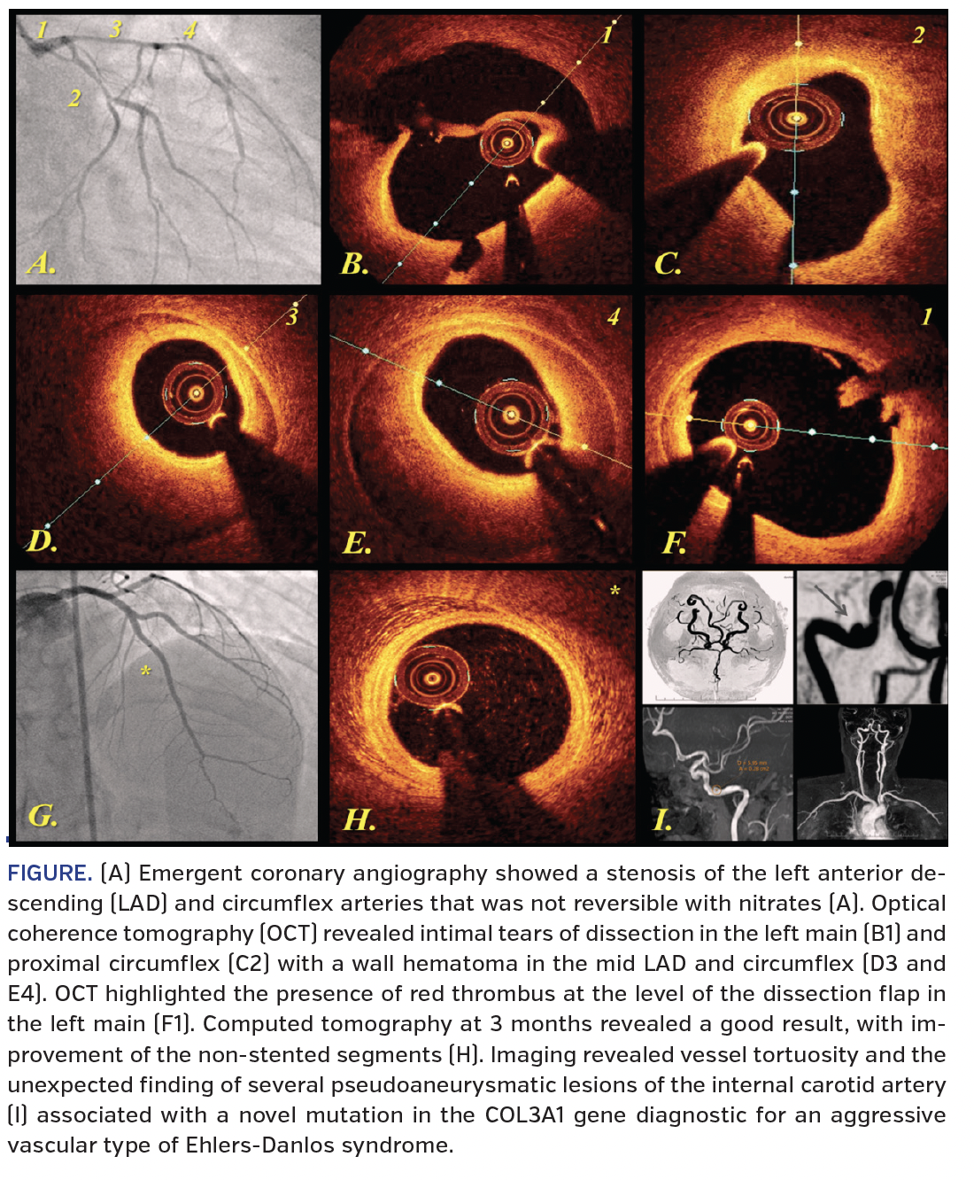 FIGURE. (A) Emergent coronary angiography