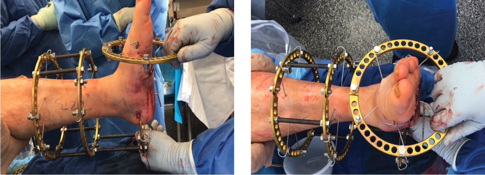 As one can see in this photo of basic midfoot Charcot neuroarthropathy external fixator configuration before final connections, the frame is adjustable to compress plantarly (left) and can twist like a “steering wheel” (right) until correction is satisfactory.